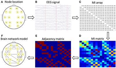 Mutual Information-Based Brain Network Analysis in Post-stroke Patients With Different Levels of Depression